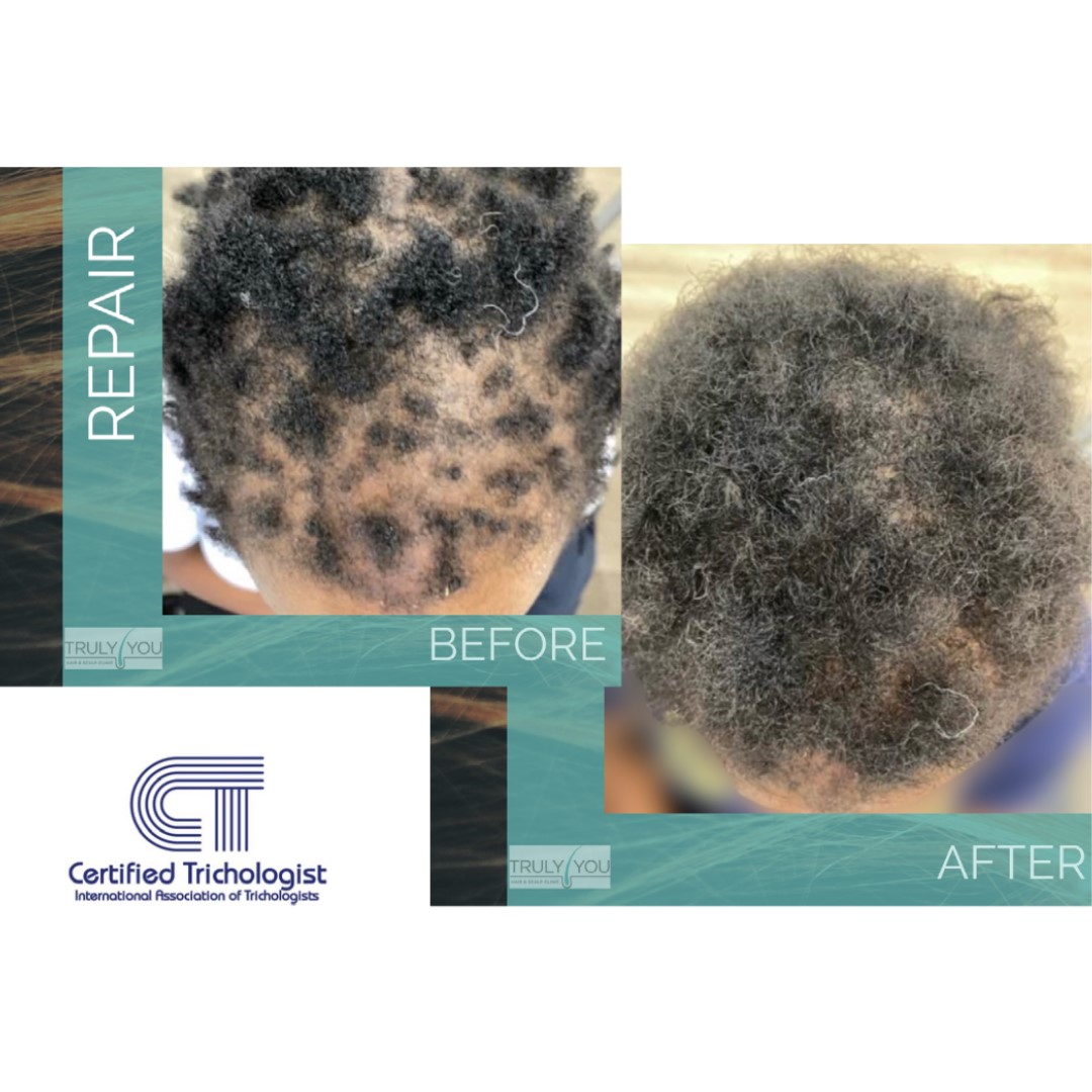 Truly You - Expert hair loss consultation at our Mississauga clinic