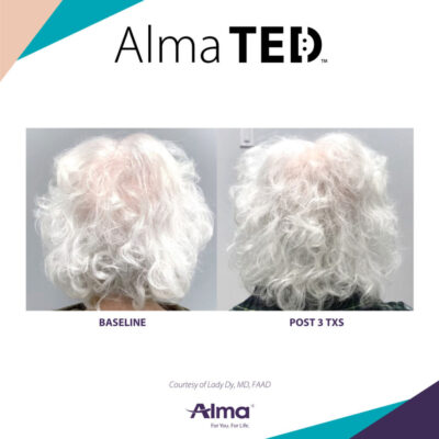 Alma TED Clinic Mississauga