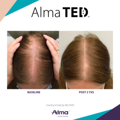 Alma TED Treatment Mississauga